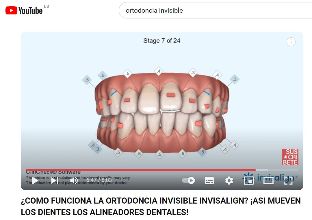 Captura de un vídeo cuyo título es ¿Cómo funciona la ortodoncia invisible invisalight? y muestra una dentadura con unos dientes que no están alineados y unas marcas en ellos.